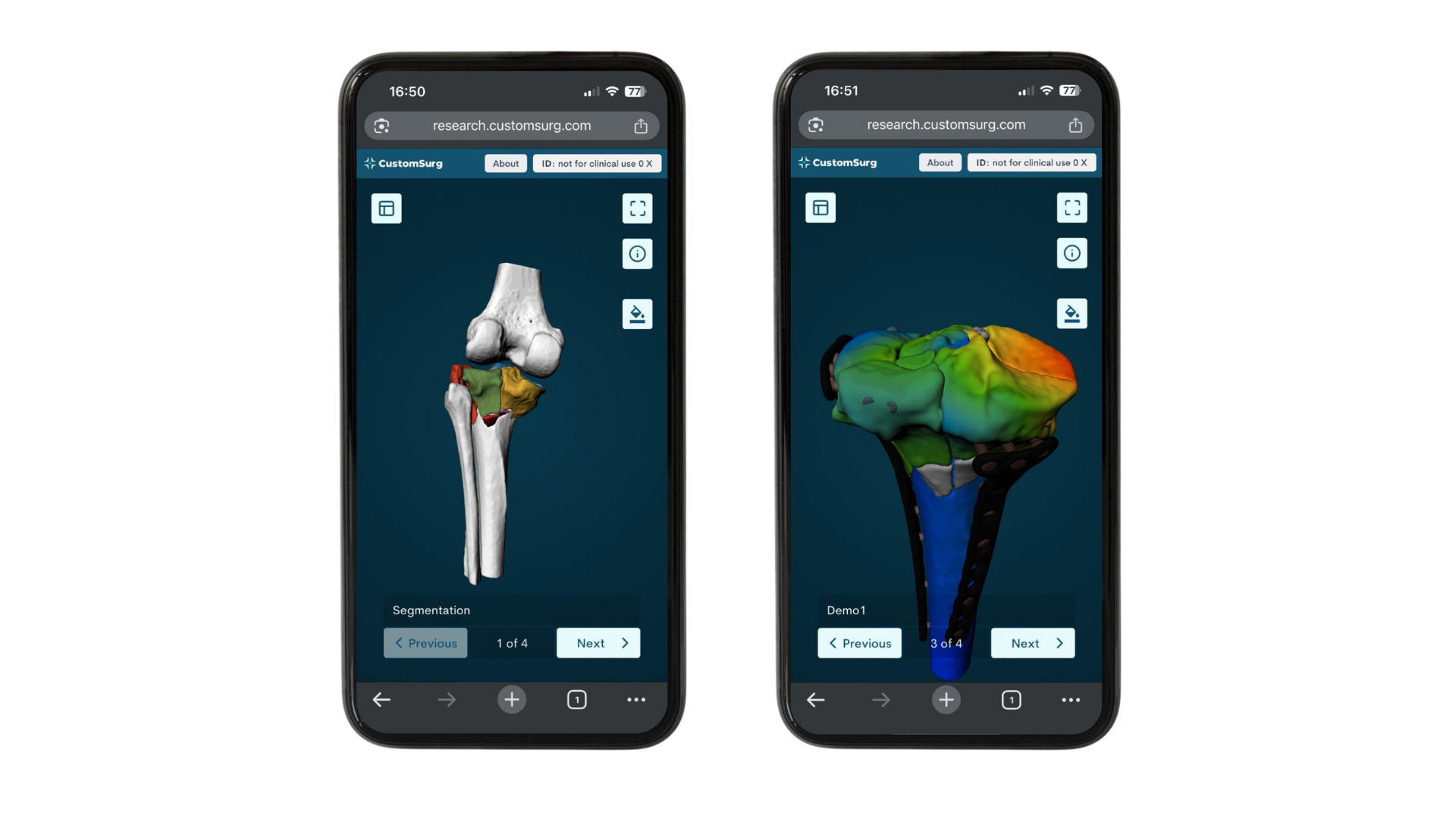 CustomSurg OrthoPlanner pre-operative fracture planning