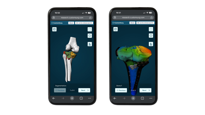 CustomSurg OrthoPlanner pre-operative fracture planning